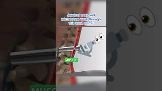 Disc Herniation Treatment (Minimally Invasive Microscope )