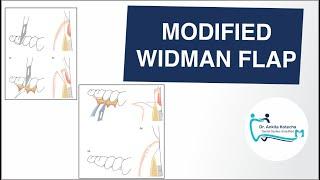 MODIFIED WIDMAN FLAP/ OPEN FLAP CURETTAGE / PERIODONTAL SURGICAL TECHNIQUE/ DR. ANKITA KOTECHA