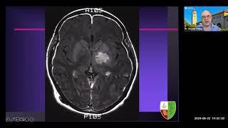 Cavernous Malformations - Diagnosis, Symptoms, Treatment