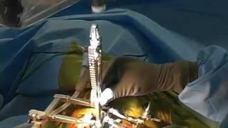 [Part 2 of 2] Synthes Spine ProDisc-C Cervical Total Disc Replacement Surgery Video