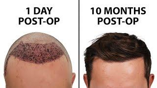 What a Hair Transplant Looks Like - Week By Week