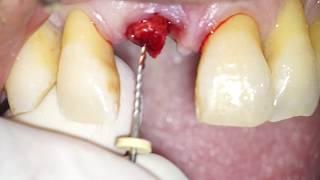 Atraumatic Root Extraction by means of an endodontic file - Dr Fabio Cozzolino