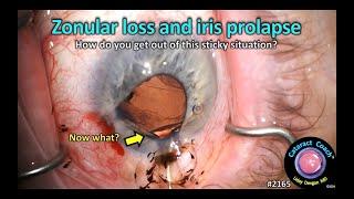 CataractCoach™ 2165: zonular loss and iris prolapse -- now what?