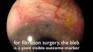 ophthaltimesepiscleral venous fluid wave and canal based surgery