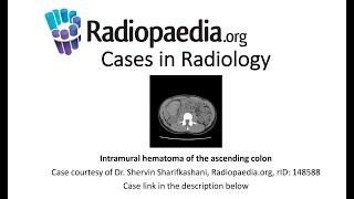 Intramural hematoma of the ascending colon (Radiopaedia.org) Cases in Radiology