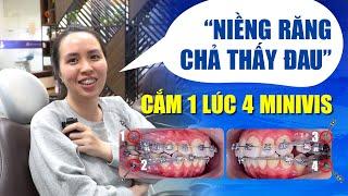 "Niềng Răng Chả Thấy Đau" - Cắm Một Lúc Bốn Minivis | Nam Bùi Vinalign