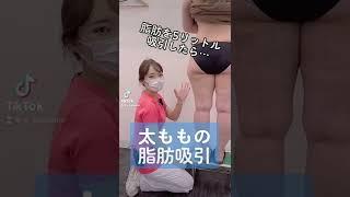 【脂肪吸引】太ももの脂肪を５リットル吸引！#shorts