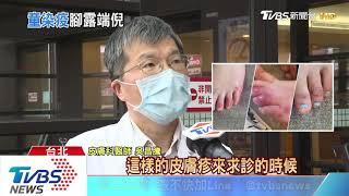 腳趾凍瘡、皰疹！美研究「無症狀者」確診徵兆