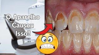 O APARELHO deixou os dentes dela todos CARIADOS!