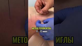 МЕТОД СУХОЙ ИГЛЫ!  #массаж #Массажиглами #школамассажа