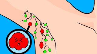 How to Ease Swollen Lymph Nodes in the Armpit