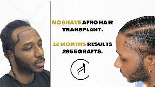 NO SHAVED Afro Hair Transplant Results - 2955 GRAFTS | 12 MONTHS