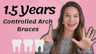 1.5 Years Update | Controlled Arch Braces