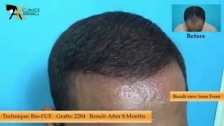 Hair Transplant result with Bio-FUE Technique of 2284 Graft : AKClinics