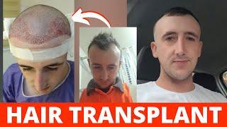 Liam from The UK got a hair transplant in Iran