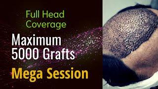 Full Head Coverage - Maximum 5000 Grafts ( Mega Session ) |#hairhub #hairtransplant #fue #islamabad