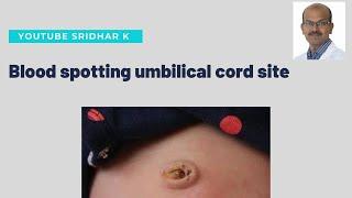 What to do if there is blood spotting at umbilical cord site. Dr Sridhar Kalyanasundaram