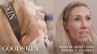 Renuva: Natural and Long-lasting Facial Rejuvenation | GOODSKIN