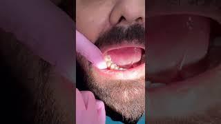 ( Metal free Crown) . Natural crowns#zirconiacrowns  #bestdentistinchandigarh