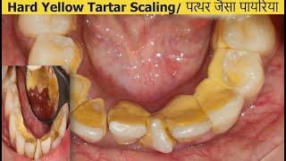 Dental Cleaning/Scaling of Tartar . Irregular teeth = More Chances of Tartar Deposits. Dr Ram MDS