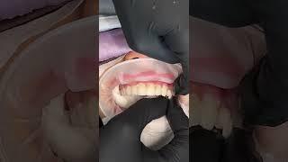 Delivering Beautiful Porcelain Veneers - Inside the Process