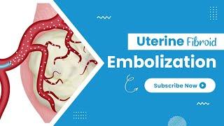 Uterine Fibroid Embolization! - TheFibroidDoc