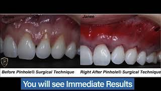 Pinhole Surgical Technique – Find A Certified Dentist