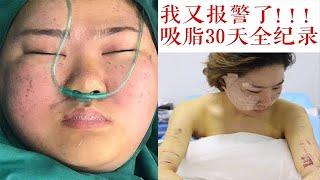 噩梦终于结束了！30天全脸大换血，抽脂/吸脂+脂肪填充恢复全记录vlog