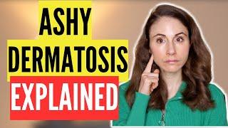 DERMATOLOGIST EXPLAINS ASHY DERMATOSIS: WHAT IS IS AND HOW TO TREAT IT