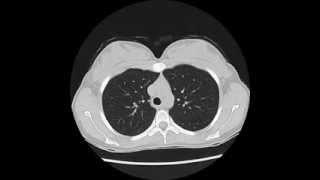 Normal Chest CT - using "lung windows"