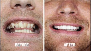 Smile Makeover ( Zirconium Crowns ) - Tommy from England