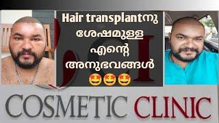 ആരും പേടിക്കണ്ട.ഇനി കഷണ്ടി...Hair Transplant ചെയ്തതിനുശേഷം ഉള്ള എന്റെ അനുഭവം... 