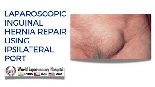 Laparoscopic TAPP Inguinal Hernia Repair Using Ipsilateral Port