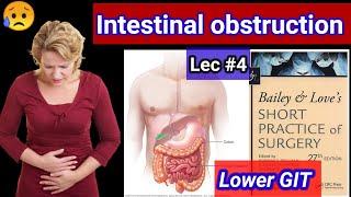 Lower GIT Surgery LECTURE #4 Strangulation and intussusception. Intestinal volvulus adhesion.