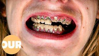 Can My Rotten Teeth Be Saved? | Our Life