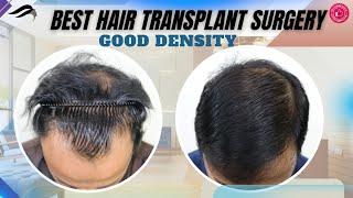 Hair Transplant In Kerala | Best Results Cost Clinic & Surgeon Of Hair Transplant In Kerala