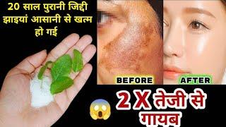 जिद्दी झाइयां हटाने का कमाल का तरीका | Reduce Melasma, Pigmentation, Discolouration, Blackspots