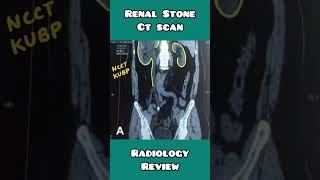 Renal stones on CT scan made simple for USMLE, NEET PG, INICET, NCLEX