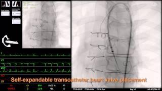 Mentice Aortic Valve Implantation (TAVI/TAVR)