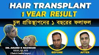 Amazing Result of Hair Transplant after 1 Year | Hair Transplant in Kolkata | Before & After |