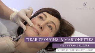 Tear Trough Filler Treatment | The Cosmetic Skin Clinic