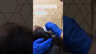 The Growth Factor Concentrate Therapy | A highly Advanced Version of The PRP treatment | GFC Therapy