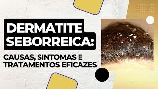 Dermatite Seborreica: Causas, Sintomas e Tratamentos Eficazes