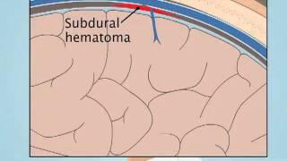 Understanding Subdural Hematoma