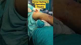 Femur Nailing in Operation Theature| Femur Bone Surgery | जांघ की हड्डी का आपरेशन | #femur #surgeon