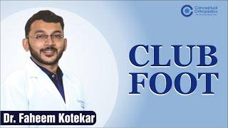 Club Foot by Dr. Faheem kotekar @Conceptual Orthopedics