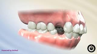 4 First Premolar Extraction for Bimaxillary Protrusion | Dental Braces | Temecula Valley, CA