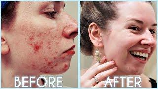 How I Cured My Acne! ️ Acne Skincare Routine & Acne Update