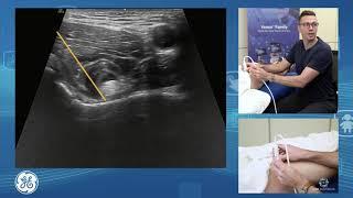 Anterior hip, iliospoas and rectus femoris for POCUS clinicians