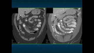 Abdominal Pain in the ER: GI Pathology - Part 1